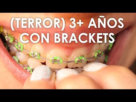 ¿Qué pasa si llevo 7 años con brackets?