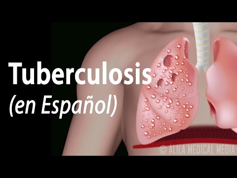 ¿Qué pasa si no se trata la tuberculosis?