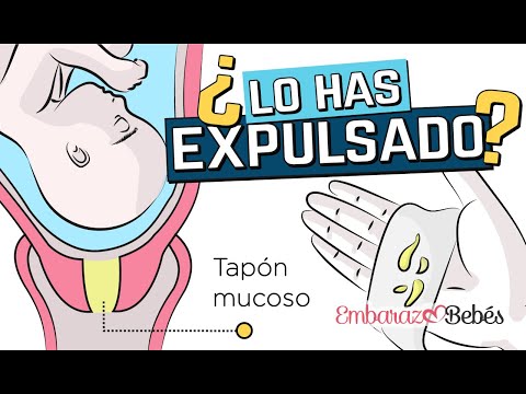 ¿Qué pasa si expulso el tapón mucoso?