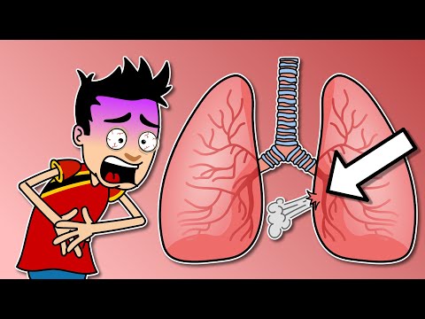 ¿Qué pasa si te perforan un pulmón?