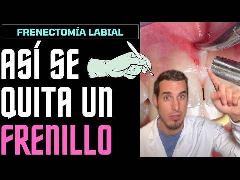 ¿Qué pasa si se rompe el frenillo labial?