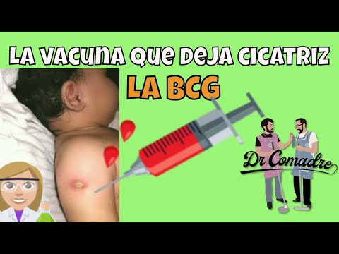 ¿Qué pasa si no tengo la vacuna BCG?