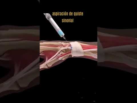 ¿Qué pasa si se revienta un quiste sinovial?