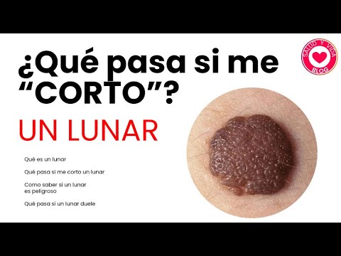 ¿Qué pasa si me arranco un lunar? Consecuencias y recomendaciones