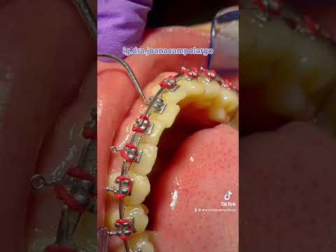 ¿Qué pasa si se me cae un bracket?