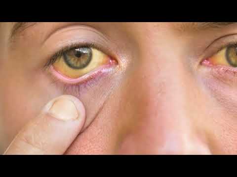 ¿Qué pasa si tengo hepatitis B?