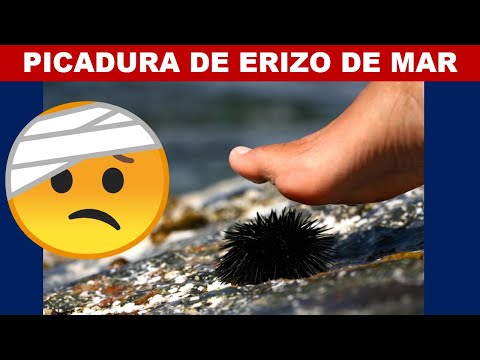 ¿Qué pasa si te pica un erizo de mar?