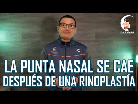 ¿Qué pasa si me río después de una rinoplastia?