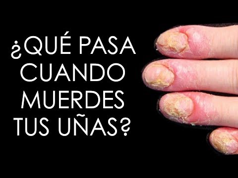 ¿Qué pasa si te comes las uñas?