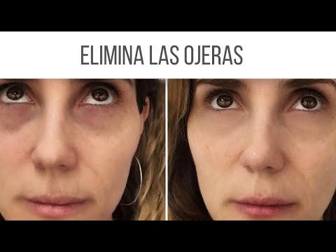 ¿Qué pasa si te pones hielo en las ojeras?