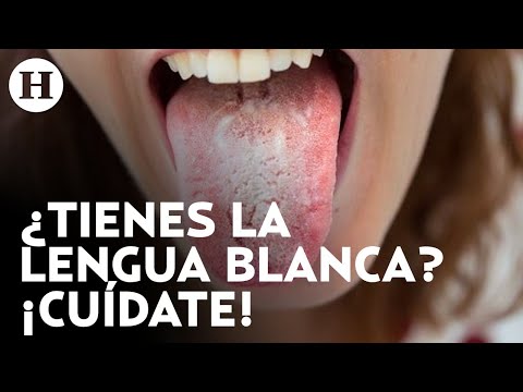 ¿Qué pasa si tienes la lengua blanca?