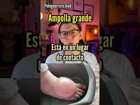 ¿Qué pasa si explotas una ampolla?