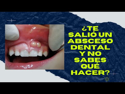 ¿Qué pasa si me reviento un absceso dental?