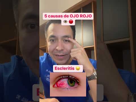 ¿Qué pasa si tengo el ojo rojo? Causas y tratamientos posibles